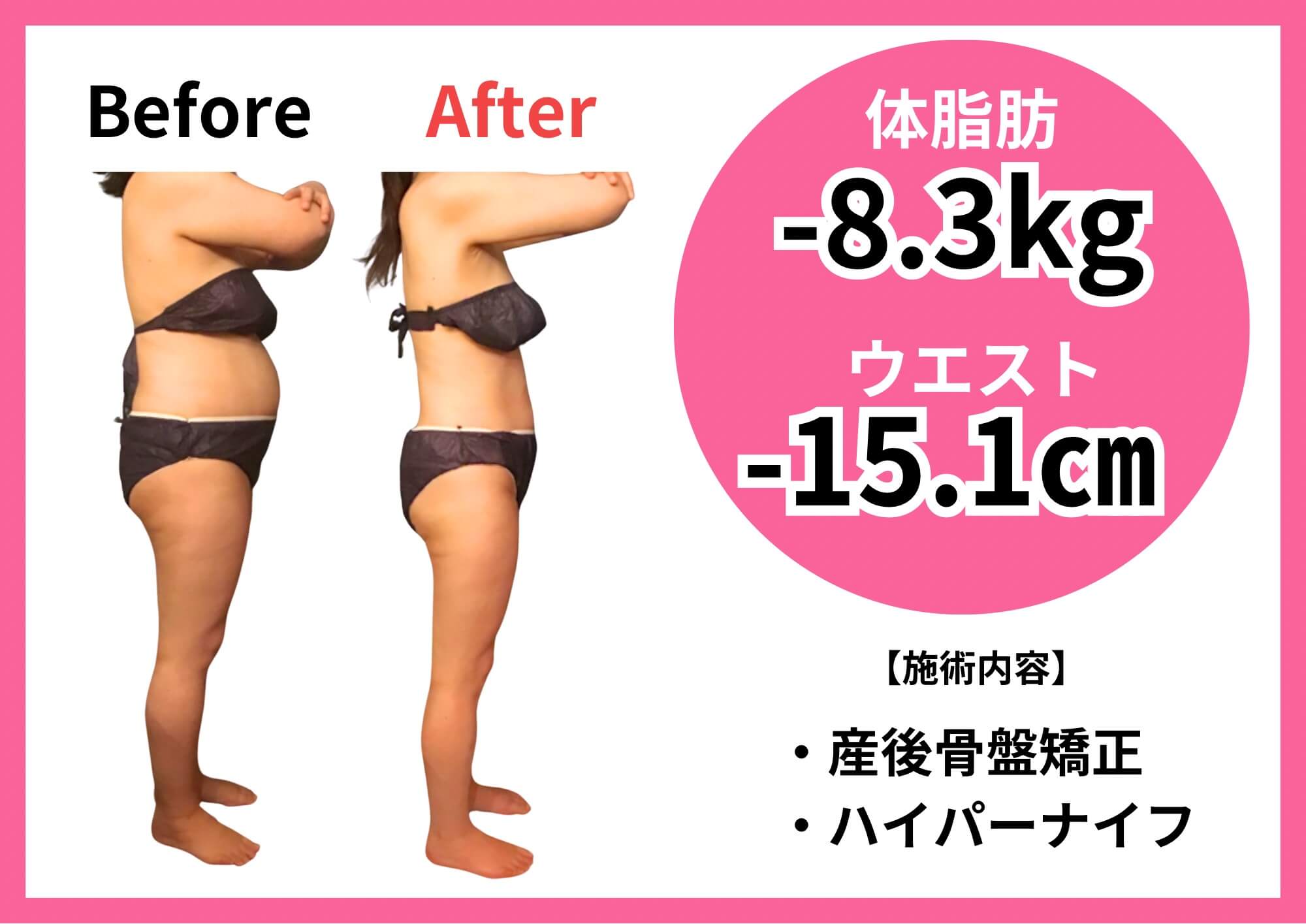 ハイパーナイフ施術 Before/After 事例1