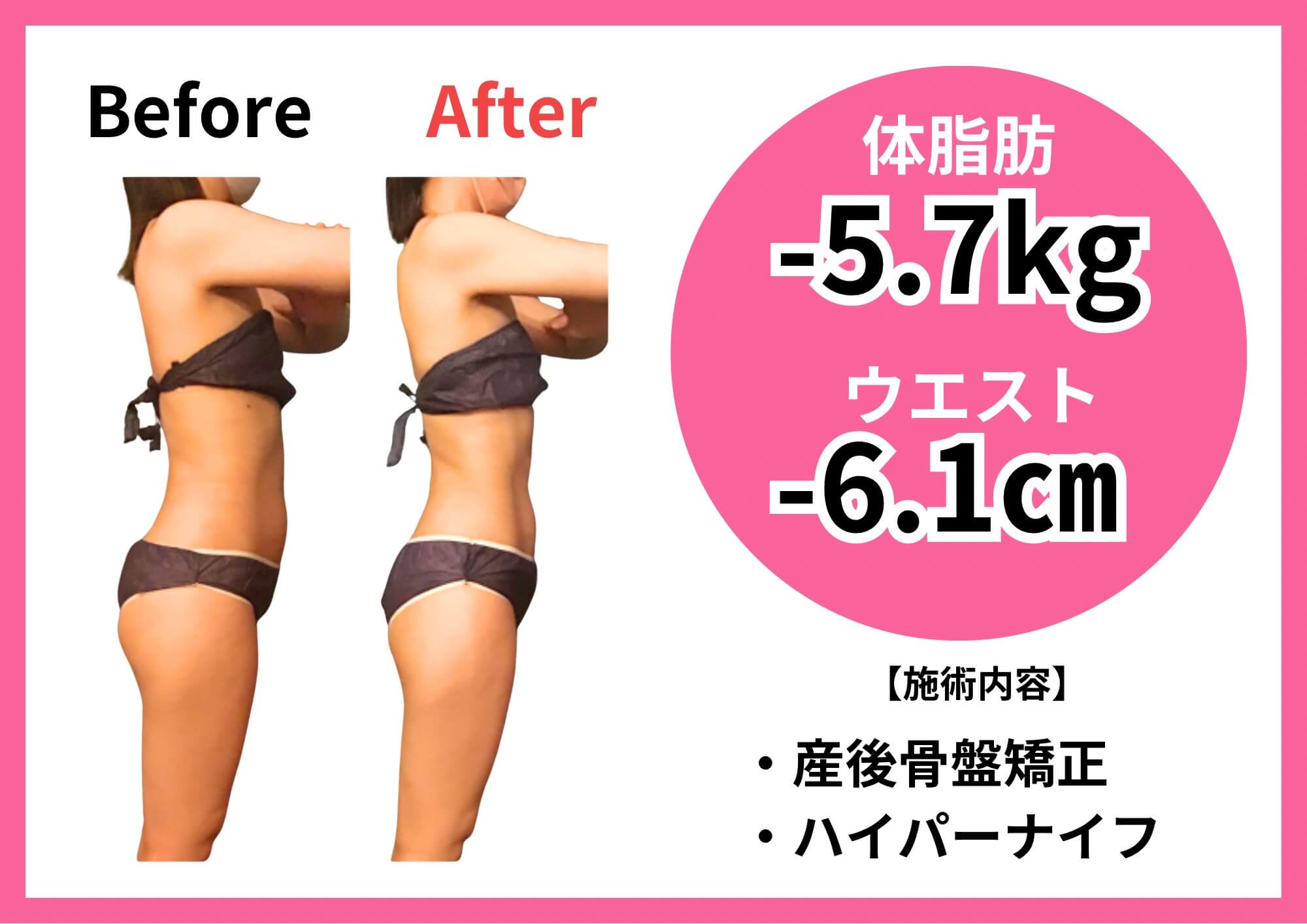 ハイパーナイフ施術 Before/After 事例2